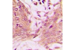 Immunohistochemical analysis of PEA15 (pS116) staining in human breast cancer formalin fixed paraffin embedded tissue section. (PEA15 antibody  (C-Term, pSer116))