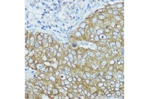 Immunohistochemistry of paraffin-embedded human breast cancer using BSCL2 antibody (ABIN7265874) at dilution of 1:100 (40x lens). (BSCL2 antibody  (AA 50-150))