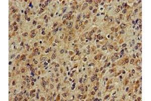 Immunohistochemistry of paraffin-embedded human glioma using ABIN7142041 at dilution of 1:100