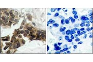 Immunohistochemistry analysis of paraffin-embedded human breast carcinoma, using IkappaB-alpha (Phospho-Ser32/Ser36) Antibody. (NFKBIA antibody  (pSer32))