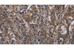 Immunohistochemistry of paraffin-embedded Human liver cancer tissue using TSC22D3 Polyclonal Antibody at dilution 1:40 (TSC22D3 antibody)