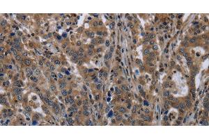 Immunohistochemistry of paraffin-embedded Human liver cancer tissue using TSC22D3 Polyclonal Antibody at dilution 1:40 (TSC22D3 antibody)