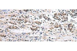 Immunohistochemistry of paraffin-embedded Human breast cancer tissue using CLCN7 Polyclonal Antibody at dilution of 1:105(x200) (CLCN7 antibody)
