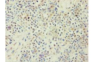 Immunohistochemistry of paraffin-embedded human breast cancer using ABIN7144925 at dilution of 1:100 (ABCF2 antibody  (AA 1-250))