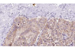ABIN6273340 at 1/100 staining Human thyroid cancer tissue by IHC-P.