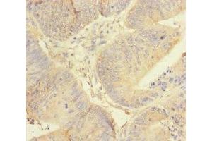 Immunohistochemistry of paraffin-embedded human colon cancer using ABIN7167451 at dilution of 1:100 (REEP5 antibody  (AA 120-189))