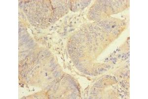 Immunohistochemistry of paraffin-embedded human colon cancer using ABIN7167451 at dilution of 1:100 (REEP5 antibody  (AA 120-189))