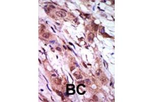 Formalin-fixed and paraffin-embedded human cancer tissue reacted with the primary antibody, which was peroxidase-conjugated to the secondary antibody, followed by AEC staining. (Aurora Kinase C antibody  (C-Term))