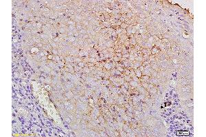 Formalin-fixed and paraffin human laryngocarcinoma labeled with Anti-CD44V10 Polyclonal Antibody, Unconjugated at 1:200, followed by conjugation to the secondary antibody and DAB staining. (CD44v10 (AA 218-227) antibody)