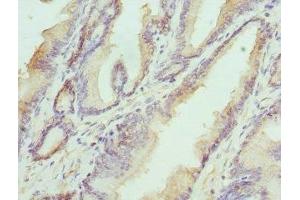 Immunohistochemistry of paraffin-embedded human prostate cancer using ABIN7155947 at dilution of 1:100 (HAPLN1 antibody  (AA 165-354))