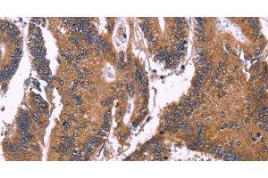 Immunohistochemistry of paraffin-embedded Human colon cancer using SEPT7 Polyclonal Antibody at dilution of 1:50 (Septin 7 antibody)