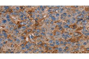 Immunohistochemistry of paraffin-embedded Human liver cancer tissue using NEDD4L Polyclonal Antibody at dilution 1:60 (NEDD4-2 antibody)