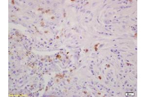 Formalin-fixed and paraffin embedded human lung carcinoma labeled with Rabbit Anti CD79A/IGBP-1 Polyclonal Antibody, Unconjugated (ABIN727578) at 1:200 followed by conjugation to the secondary antibody and DAB staining (IGBP1 antibody  (AA 151-250))