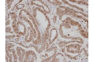 IHC-P Image Immunohistochemical analysis of paraffin-embedded human thyroid cancer, using CAMK1D , antibody at 1:100 dilution.