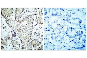 Immunohistochemical analysis of paraffin-embedded breast carcinoma, using MKK6 (epitope around residue 207) Antibody (ABIN5976227). (MAP2K3 antibody  (Ser207))