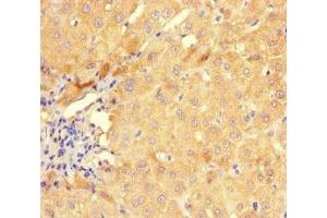Immunohistochemistry of paraffin-embedded human liver cancer using ABIN7154281 at dilution of 1:100 (GMPR antibody  (AA 1-345))