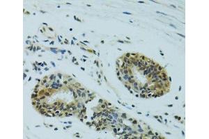 Immunohistochemistry of paraffin-embedded Human breast cancer using NHEJ1 Polyclonal Antibody at dilution of 1:100 (40x lens). (NHEJ1 antibody)