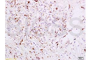 Formalin-fixed and paraffin embedded human liver carcinoma tissue labeled with Anti-phospho-STAT6(Tyr641) Polyclonal Antibody, Unconjugated (ABIN734483) at 1:200 followed by conjugation to the secondary antibody, (SP-0023), and DAB staining