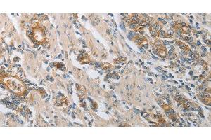 Immunohistochemistry of paraffin-embedded Human gastic cancer using CST3 Polyclonal Antibody at dilution of 1:50 (CST3 antibody)