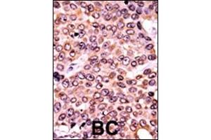 Formalin-fixed and paraffin-embedded human cancer tissue reacted with the primary antibody, which was peroxidase-conjugated to the secondary antibody, followed by AEC staining. (p21 antibody  (pThr145))