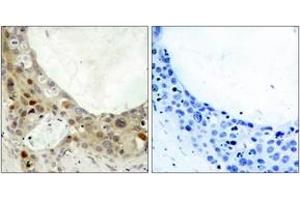 Immunohistochemistry analysis of paraffin-embedded human breast carcinoma, using BCL-2 (Phospho-Ser70) Antibody.