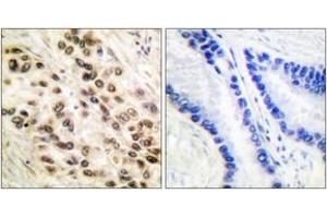 Immunohistochemistry analysis of paraffin-embedded human lung carcinoma tissue, using C/EBP-beta (Ab-235/188) Antibody. (CEBPB antibody  (AA 201-250))