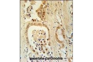 Z385B Antibody (N-term) (ABIN651975 and ABIN2840480) immunohistochemistry analysis in formalin fixed and paraffin embedded human prostate carcinoma followed by peroxidase conjugation of the secondary antibody and DAB staining. (ZNF385B antibody  (AA 1-30))