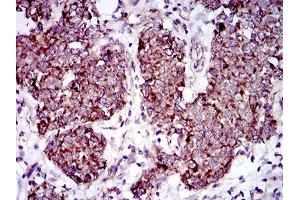Immunohistochemical analysis of paraffin-embedded breast cancer tissues using MRPL42 mouse mAb with DAB staining. (MRPL42 antibody  (AA 10-142))