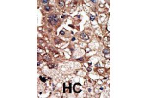 Formalin-fixed and paraffin-embedded human hepatocellular carcinoma tissue reacted with EPS8 polyclonal antibody  , which was peroxidase-conjugated to the secondary antibody, followed by DAB staining. (EPS8 antibody  (N-Term))