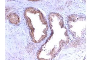 Formalin-fixed, paraffin-embedded human Prostate Carcinoma stained with PSA Rabbit Recombinant Monoclonal Antibody (KLK3/2871R). (Recombinant Prostate Specific Antigen antibody)