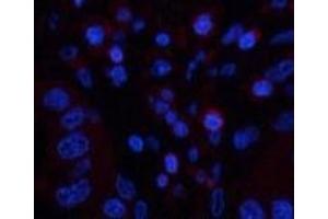 Immunofluorescence analysis of Human liver cancer tissue using CD45 Monoclonal Antibody at dilution of 1:200. (CD45 antibody)