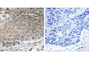 Peptide - +Immunohistochemistry analysis of paraffin-embedded human lung carcinoma tissue using DYNLL2 antibody. (DYNLL2 antibody)