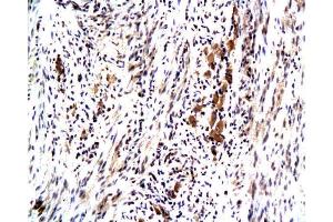 Formalin-fixed and paraffin embedded human colon carcinoma with Anti-Maspin Polyclonal Antibody, Unconjugated at 1:200, followed by conjugation to the secondary antibody and DAB staining