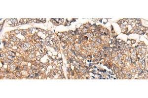 Immunohistochemistry of paraffin-embedded Human esophagus cancer tissue using CACNA2D2 Polyclonal Antibody at dilution of 1:45(x200) (CACNA2D2 antibody)