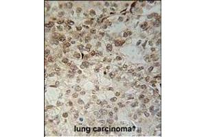 C14orf179 Antibody (Center) (ABIN651563 and ABIN2840304) immunohistochemistry analysis in formalin fixed and paraffin embedded human lung carcinoma followed by peroxidase conjugation of the secondary antibody and DAB staining.