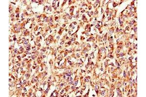 Immunohistochemistry of paraffin-embedded human melanoma using ABIN7158215 at dilution of 1:100 (LSMEM1 antibody  (AA 1-131))