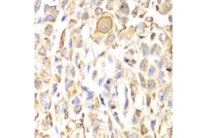 Immunohistochemistry of paraffin-embedded human lung cancer using CD151 antibody (ABIN3023660, ABIN3023661, ABIN3023662, ABIN1679069 and ABIN6219074) at dilution of 1:200 (40x lens). (CD151 antibody  (AA 113-221))