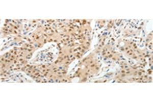 Immunohistochemistry of paraffin-embedded Human lung cancer tissue using UNC5CL Polyclonal Antibody at dilution of 1:50(x200) (UNC5CL antibody)