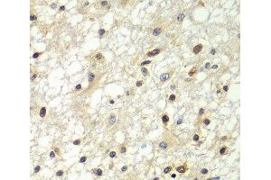 Immunohistochemistry of paraffin-embedded Human brain cancer using ZBTB48 Polyclonal Antibody at dilution of 1:100 (40x lens). (ZBTB48 antibody)