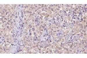 ABIN6273343 at 1/100 staining Human thyroid cancer tissue by IHC-P. (VDAC3 antibody  (N-Term))