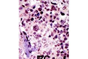 Formalin-fixed and paraffin-embedded human cancer tissue reacted with the primary antibody, which was peroxidase-conjugated to the secondary antibody, followed by AEC staining. (Protein Kinase A beta (AA 50-80), (N-Term), (Regulatory Subunit 1) antibody)