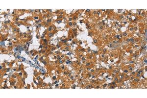 Immunohistochemistry of paraffin-embedded Human thyroid cancer using KLF7 Polyclonal Antibody at dilution of 1:60 (KLF7 antibody)