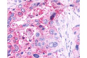 Anti-GPR61 antibody IHC of human Pancreas, Carcinoma. (GPR61 antibody  (C-Term))