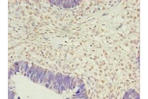 Immunohistochemistry of paraffin-embedded human ovarian cancer using ABIN7163399 at dilution of 1:100 (PRTFDC1 antibody  (AA 2-225))