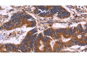 Immunohistochemistry of paraffin-embedded Human colon cancer tissue using KIR2DL1/3/4/S4 Polyclonal Antibody at dilution 1:30 (KIR2DL1/3/4/S4 antibody)