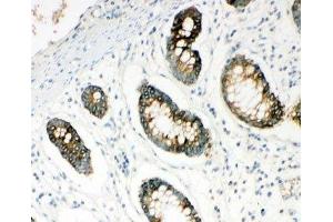 IHC-P: HYAL1 antibody testing of human intestine cancer tissue