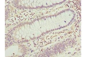 Immunohistochemistry of paraffin-embedded human colon cancer using ABIN7165174 at dilution of 1:100 (TNRC5 antibody  (AA 31-278))