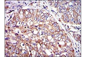 Immunohistochemical analysis of paraffin-embedded lung cancer tissues using CRK mouse mAb with DAB staining. (Crk antibody)