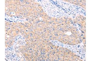 The image on the left is immunohistochemistry of paraffin-embedded Human cervical cancer tissue using ABIN7131482(TRIM32 Antibody) at dilution 1/40, on the right is treated with fusion protein. (TRIM32 antibody)