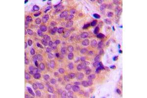 Immunohistochemical analysis of MMP2 staining in human breast cancer formalin fixed paraffin embedded tissue section. (MMP2 antibody  (C-Term))